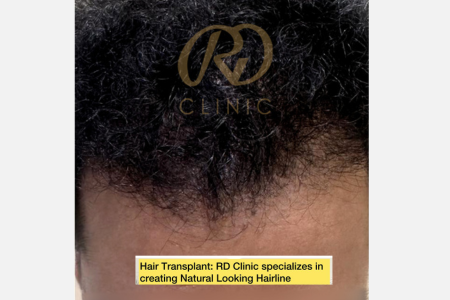 Hair Loss Treatment — after