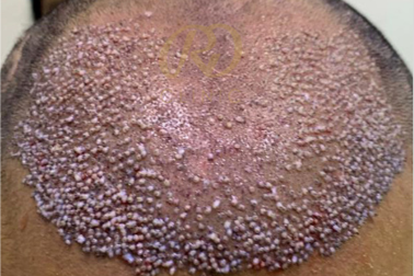 Hair Loss Treatment — before