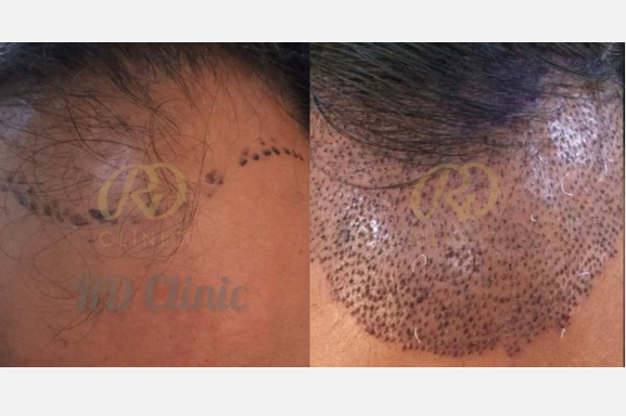 Hair Loss Treatment — before