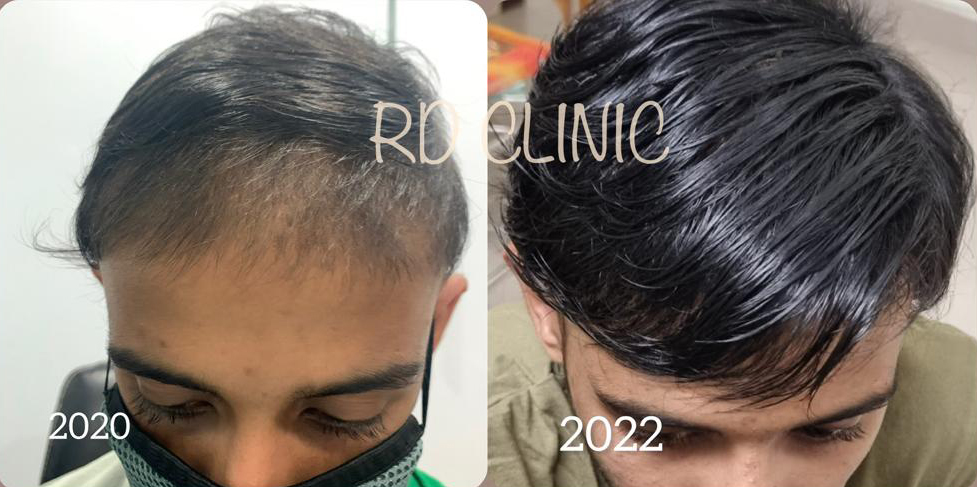 Hair Loss Treatment — after