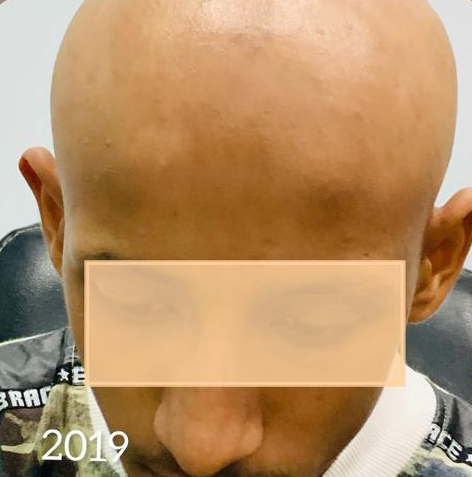 Hair Loss Treatment — before