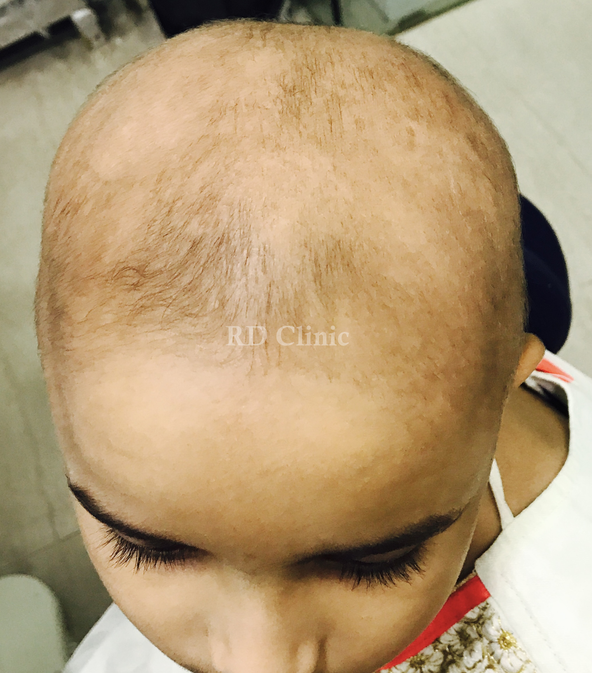 Alopecia Totalis Treatment — before