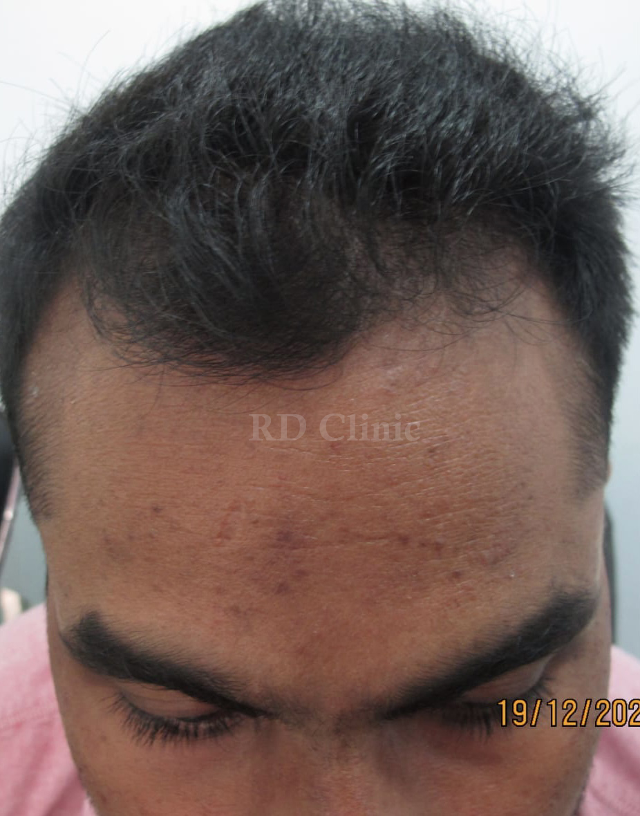 Hair Loss Treatment — before