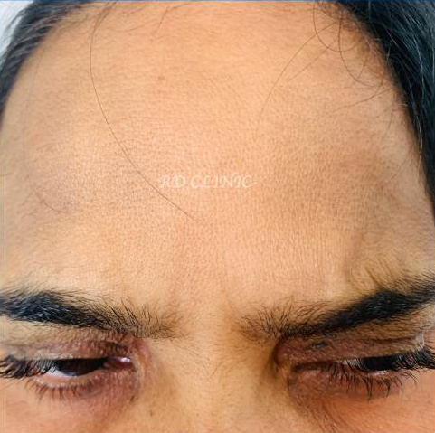 Reduction in forehead wrinkles — after