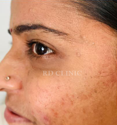 Crowfeet wrinkle reduction — after