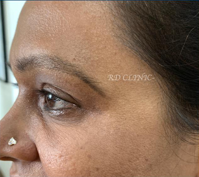 Crowfeet wrinkle reduction — after