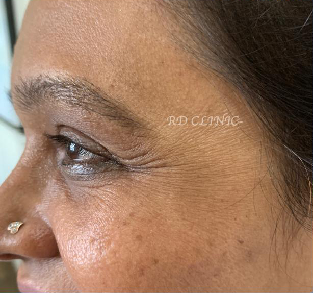 Crowfeet wrinkle reduction — before