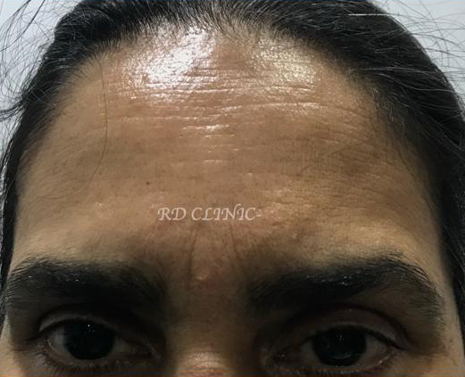 Reduction in forehead wrinkles — after