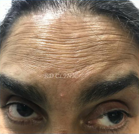 Reduction in forehead wrinkles — before