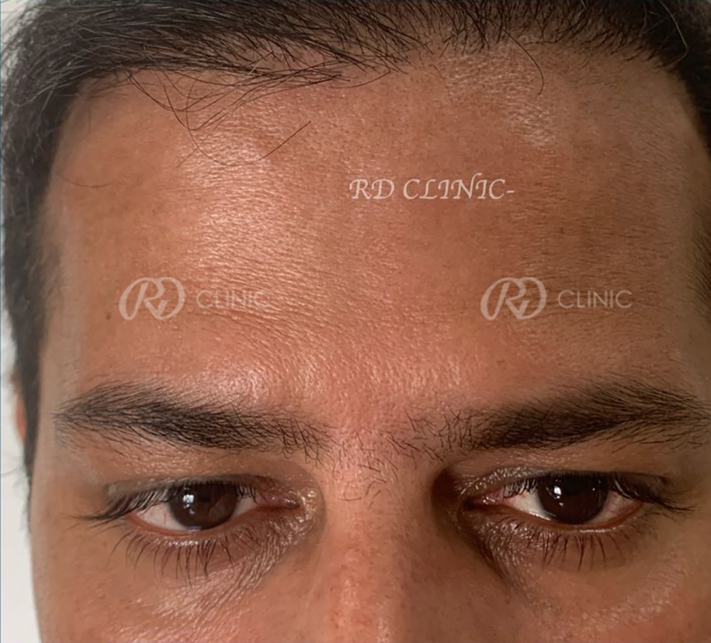 Crowfeet wrinkle reduction — after