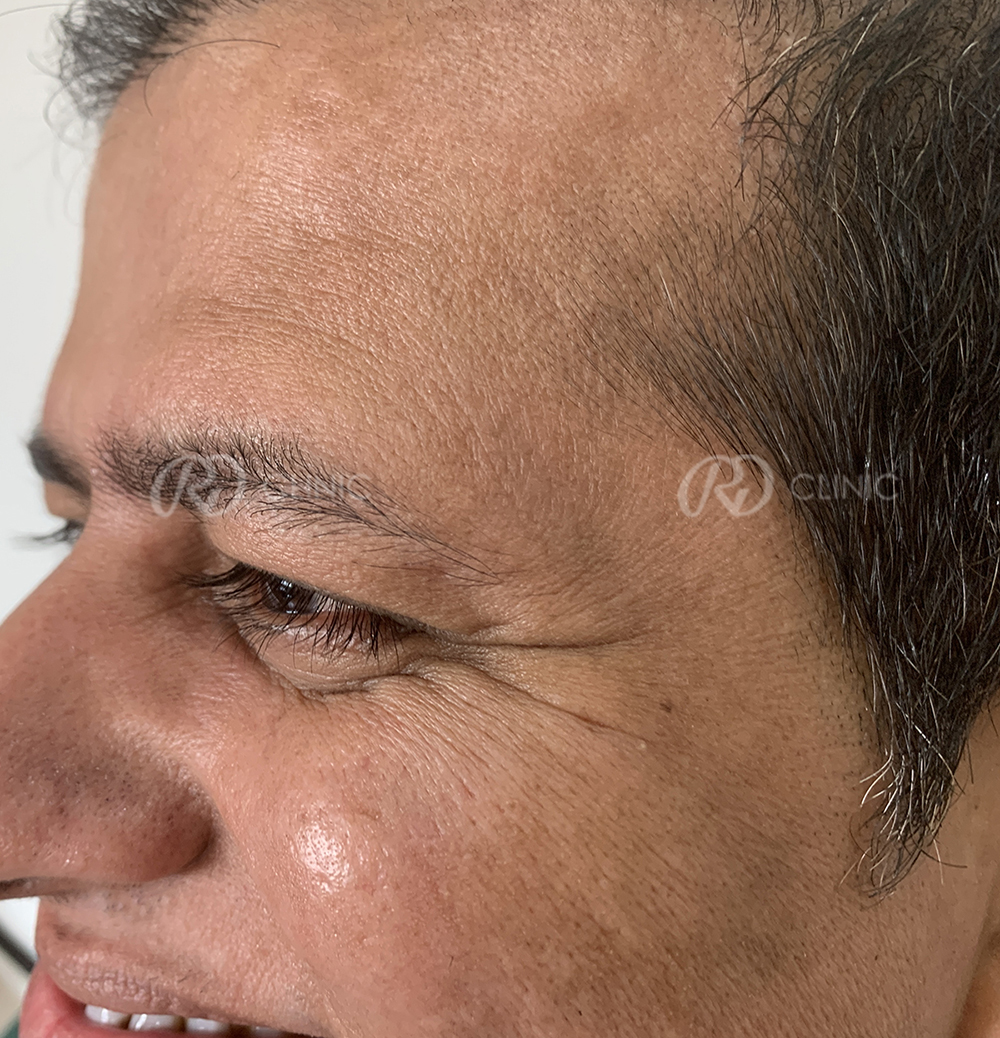 Crowfeet wrinkle reduction — before