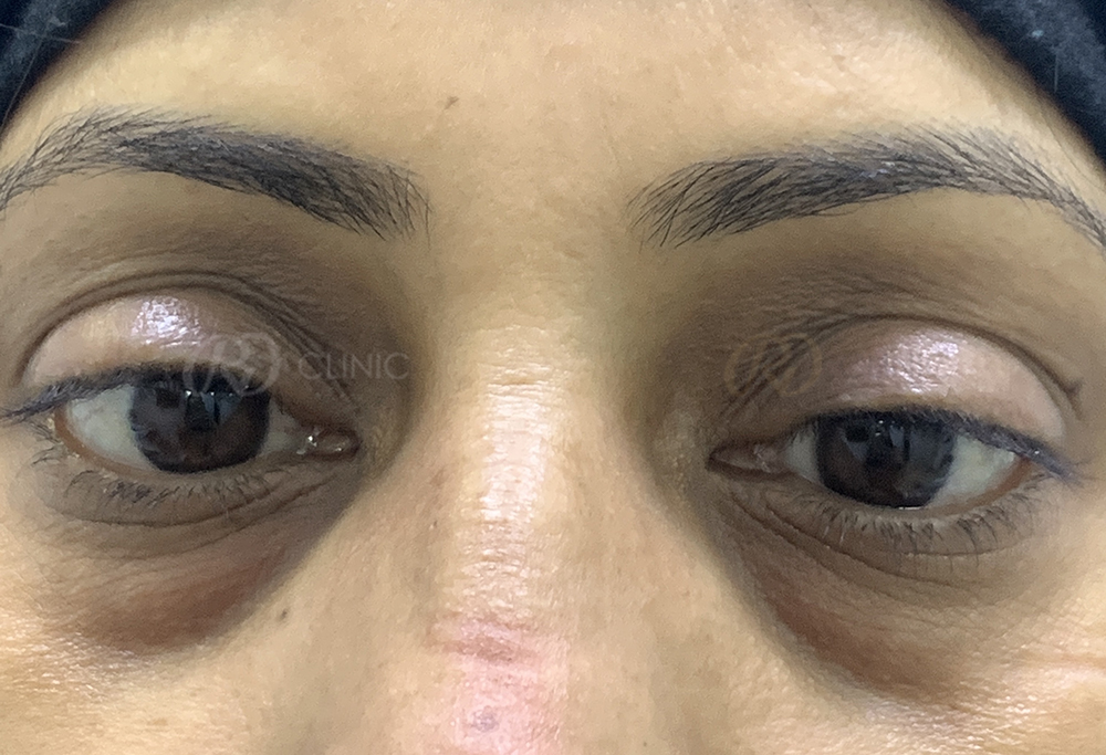 Tear trough correction with filler — before