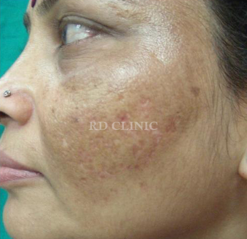 Acne Treatment — after
