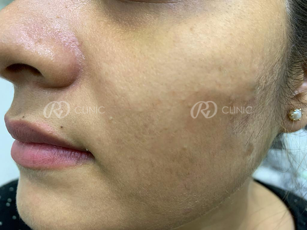 Comedone Removal — after