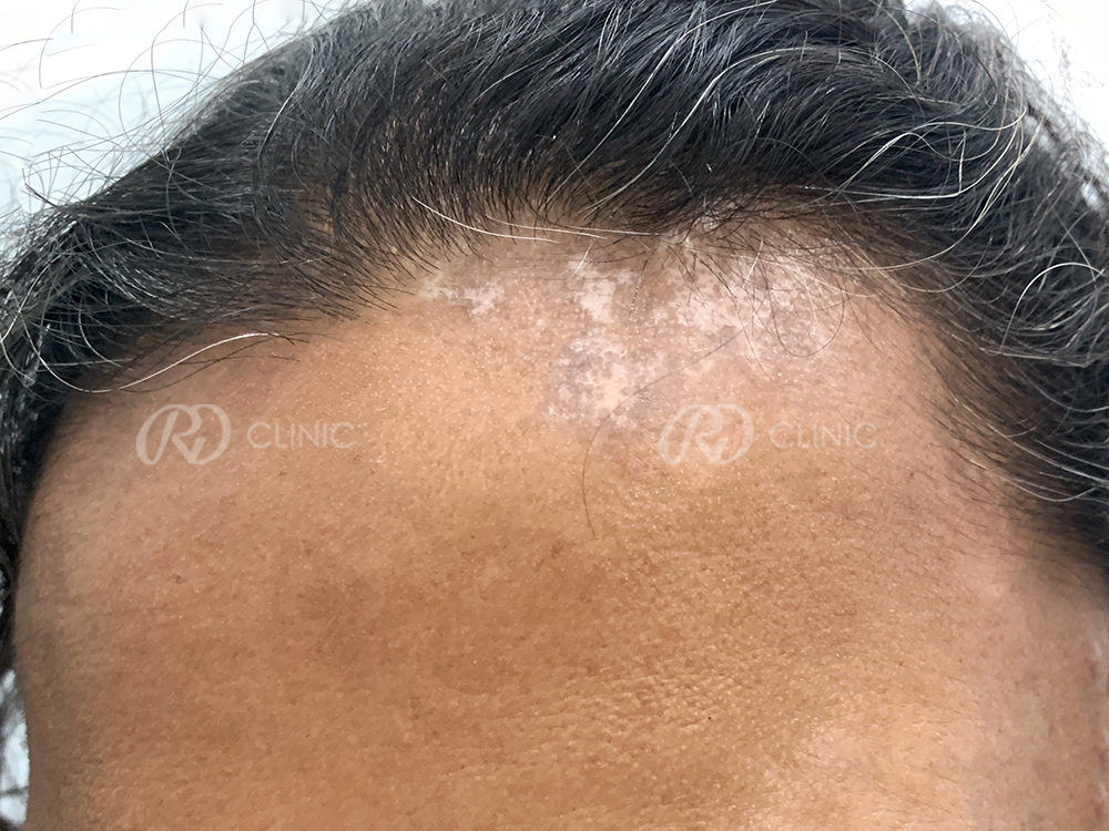 Skin Treatment: Response with melanocytes transfer — before