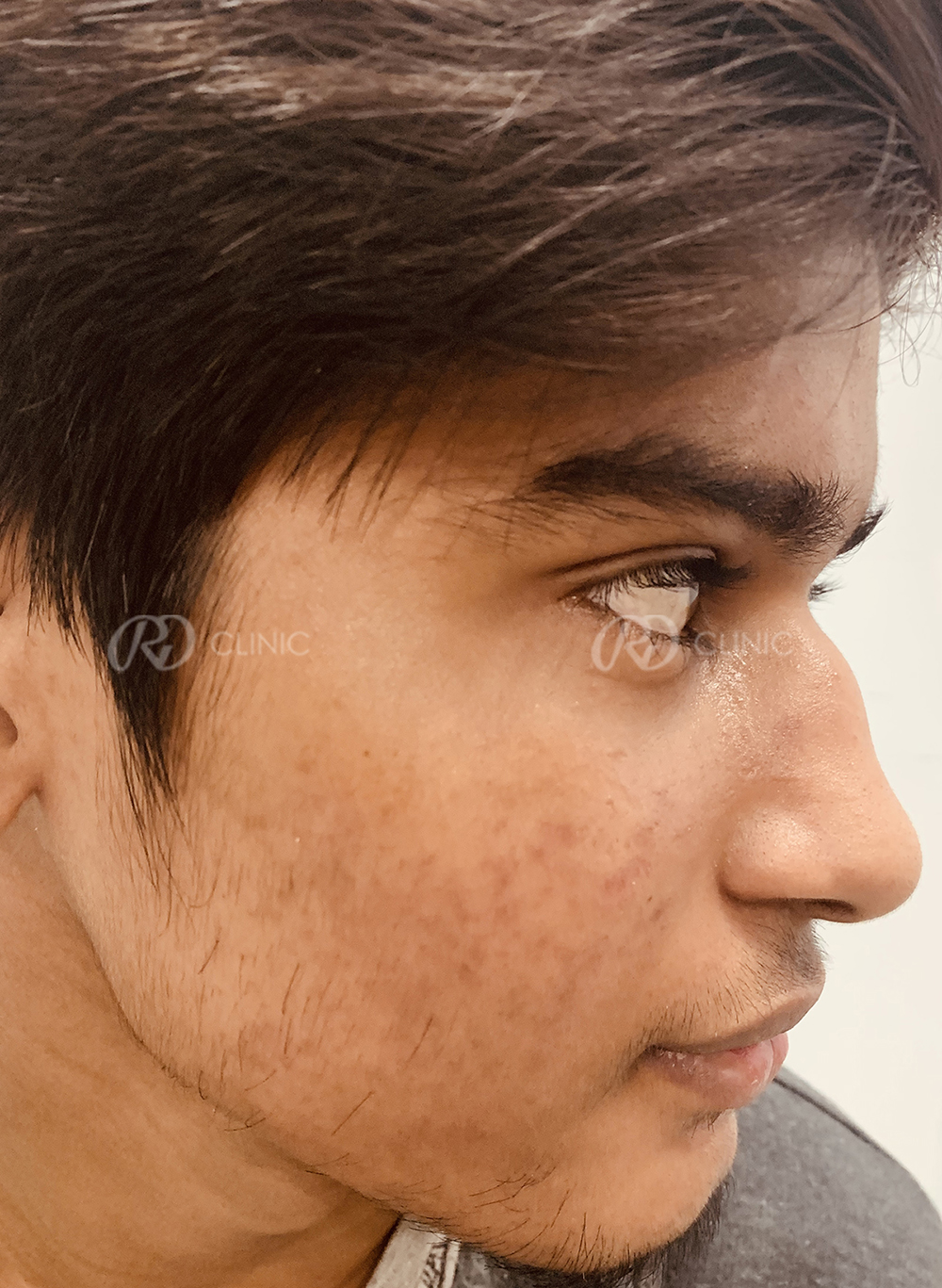 Acne Treatment — after