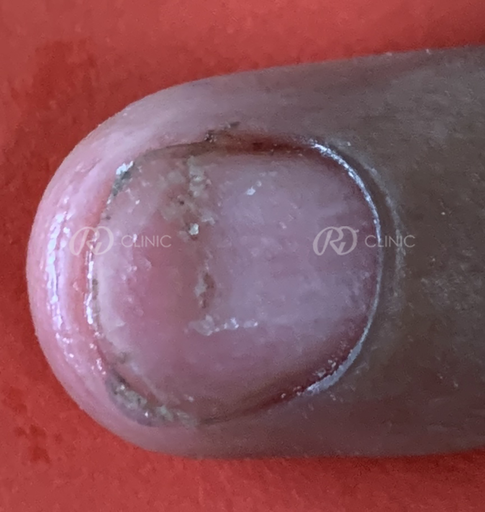 Nail Rejuvenation — after