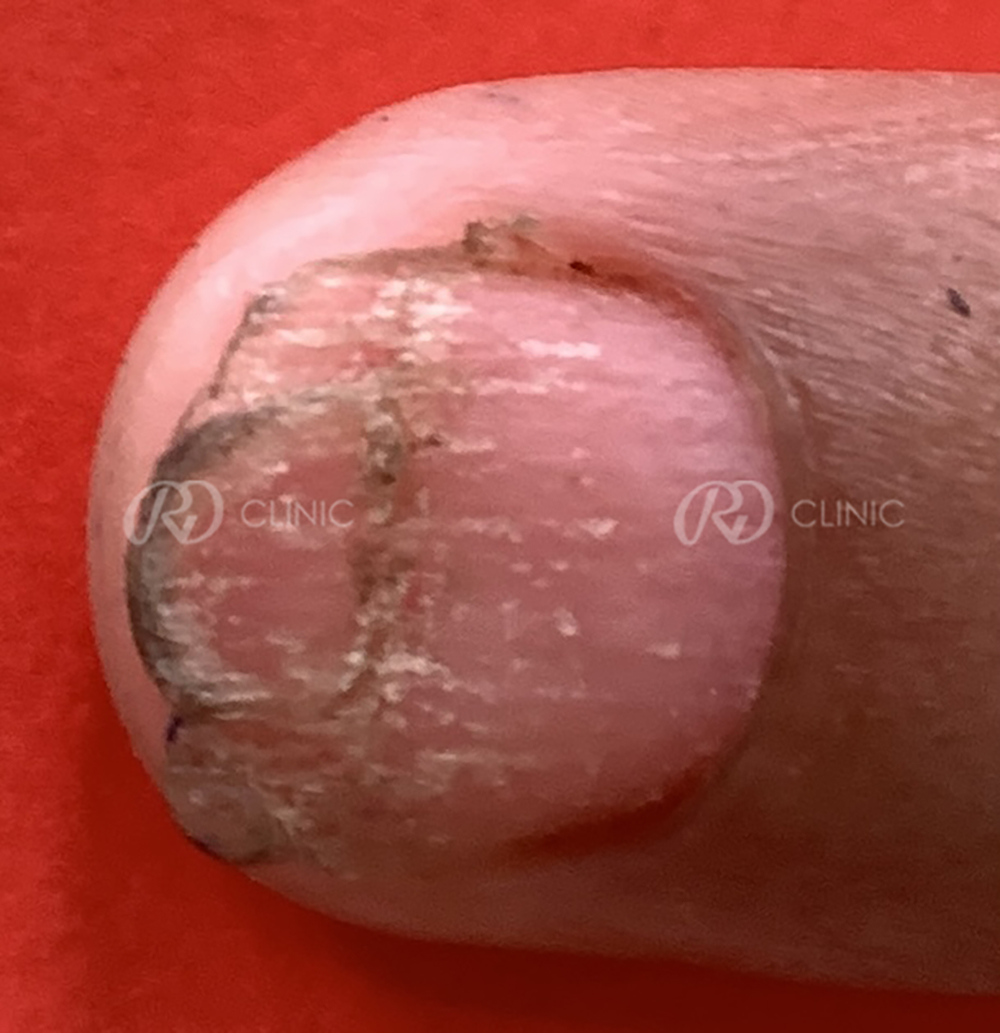 Nail Rejuvenation — before