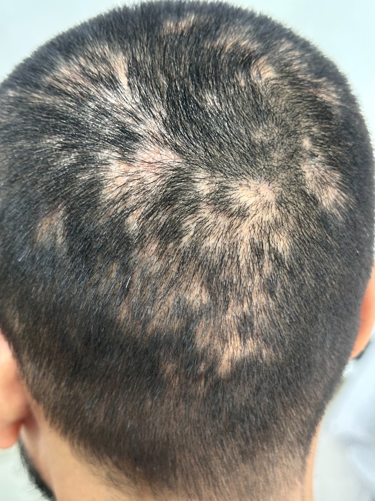 Cicatricial Alopecia