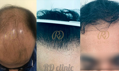 Before and after result 1