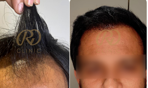 Before and after result 5