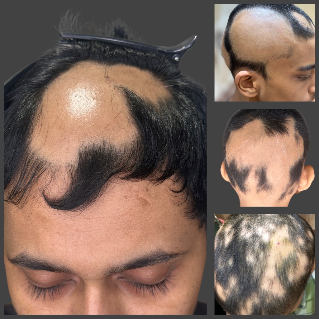 Alopecia Areata