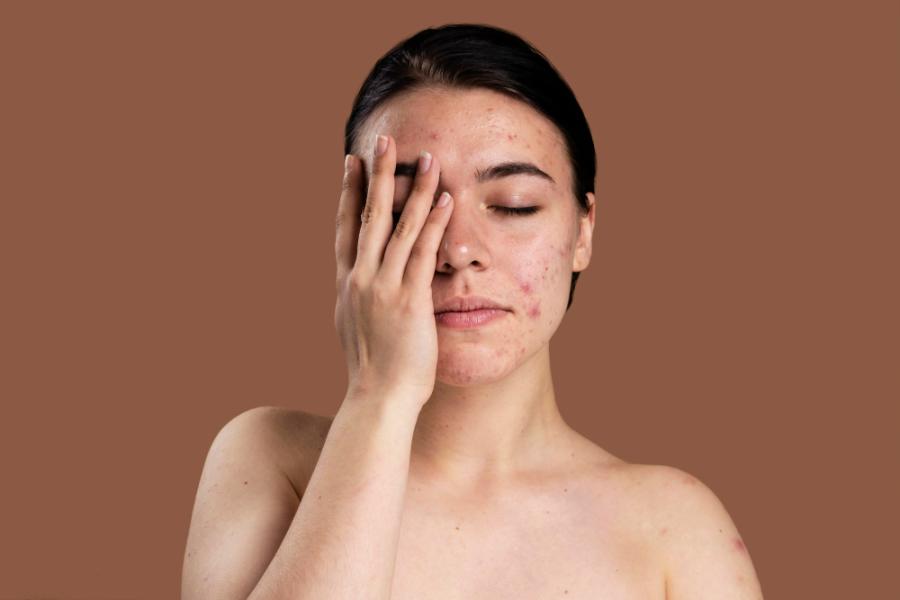 Pigmentation and Acne