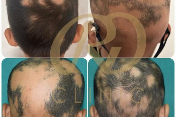 Advanced Treatment for Children with Alopecia Areata
