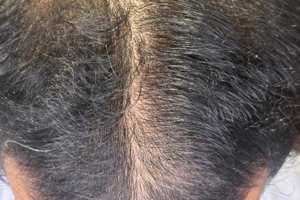 Androgenetic Alopecia