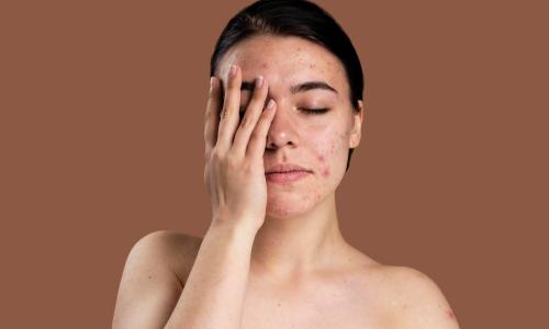 Pigmentation and Acne